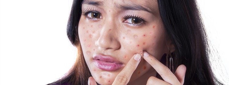 acne-medical-solutions
